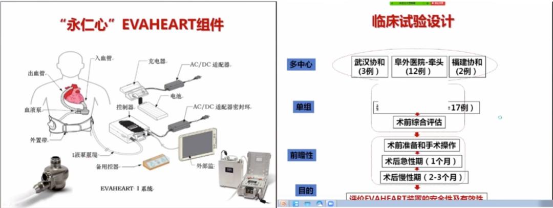胡盛寿院士：左心辅助装置在中国的研究和应用