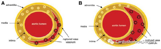 Circulation丨主动脉壁内血肿综述