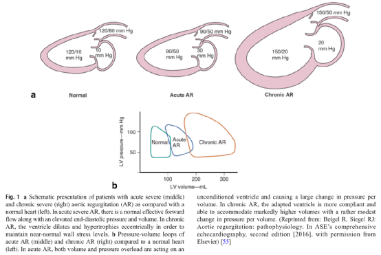 Curr Cardiol Rep丨主动脉反流