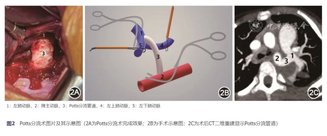 【病例报告】急诊Potts分流术治疗儿童特发性重度肺动脉高压一例