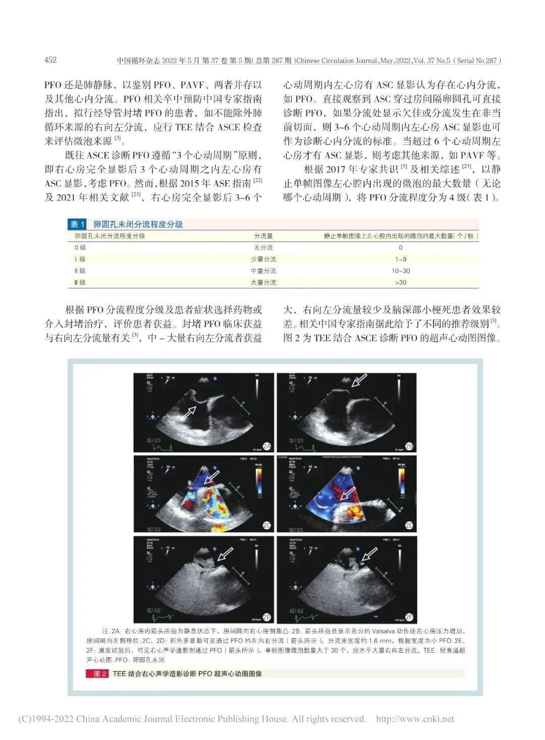 卵圆孔未闭该如何诊疗？我国最新专家共识来了！