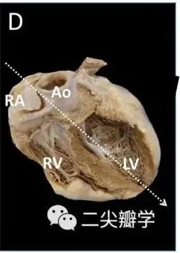 三尖瓣关闭不全病理生理、严重程度分级和预后的最新进展