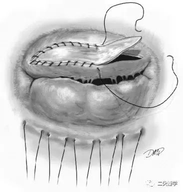 阜外凤玮等综述：功能性二尖瓣关闭不全手术治疗策略