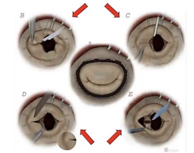 风湿性二尖瓣修复SCORE术式：外科原则、病理洞见与功能哲学的融合